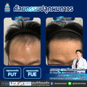 ปลูกผม ผู้ชาย