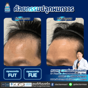 ปลูกผม ผู้ชาย