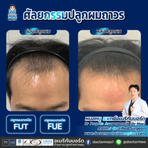 ปลูกผม ผู้ชาย