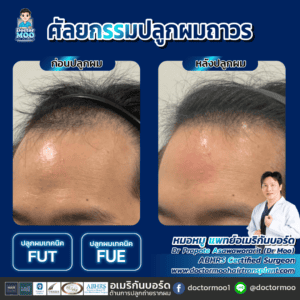 ปลูกผม ผู้ชาย