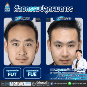 ปลูกผม ผู้ชาย