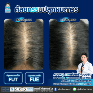 ปลูกผม ผู้ชาย