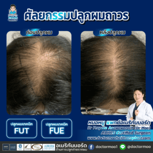 ปลูกผม ผู้ชาย