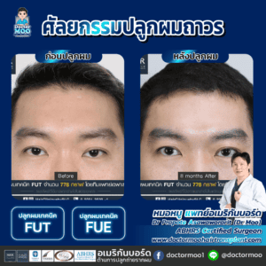 ปลูกผม ผู้ชาย