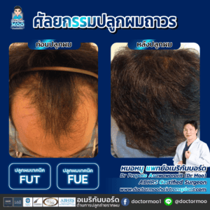 ปลูกผม ผู้ชาย