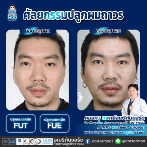 ปลูกผม ผู้ชาย