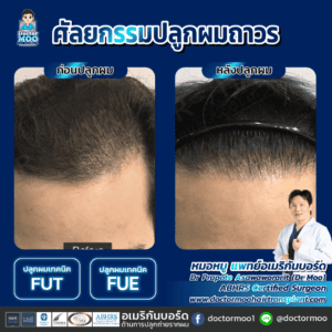 ปลูกผม ผู้ชาย