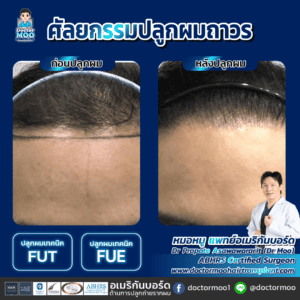 ปลูกผม ผู้ชาย