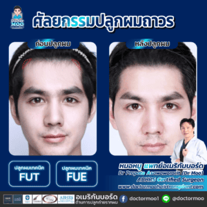 ปลูกผม ผู้ชาย