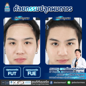 ปลูกผม ผู้ชาย