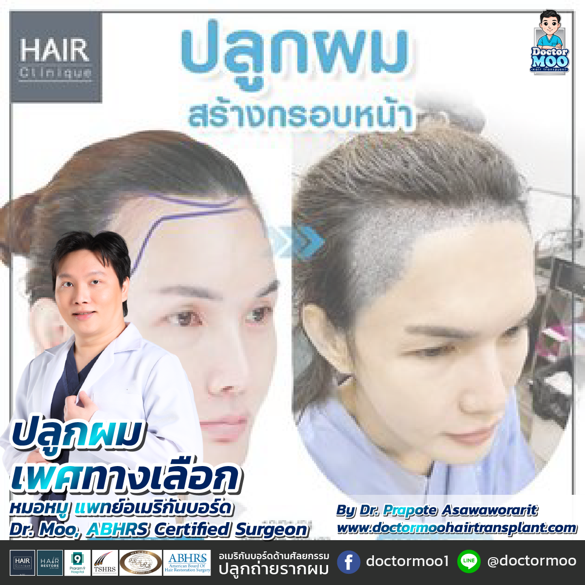 ปลูกผม เพศทางเลือก
