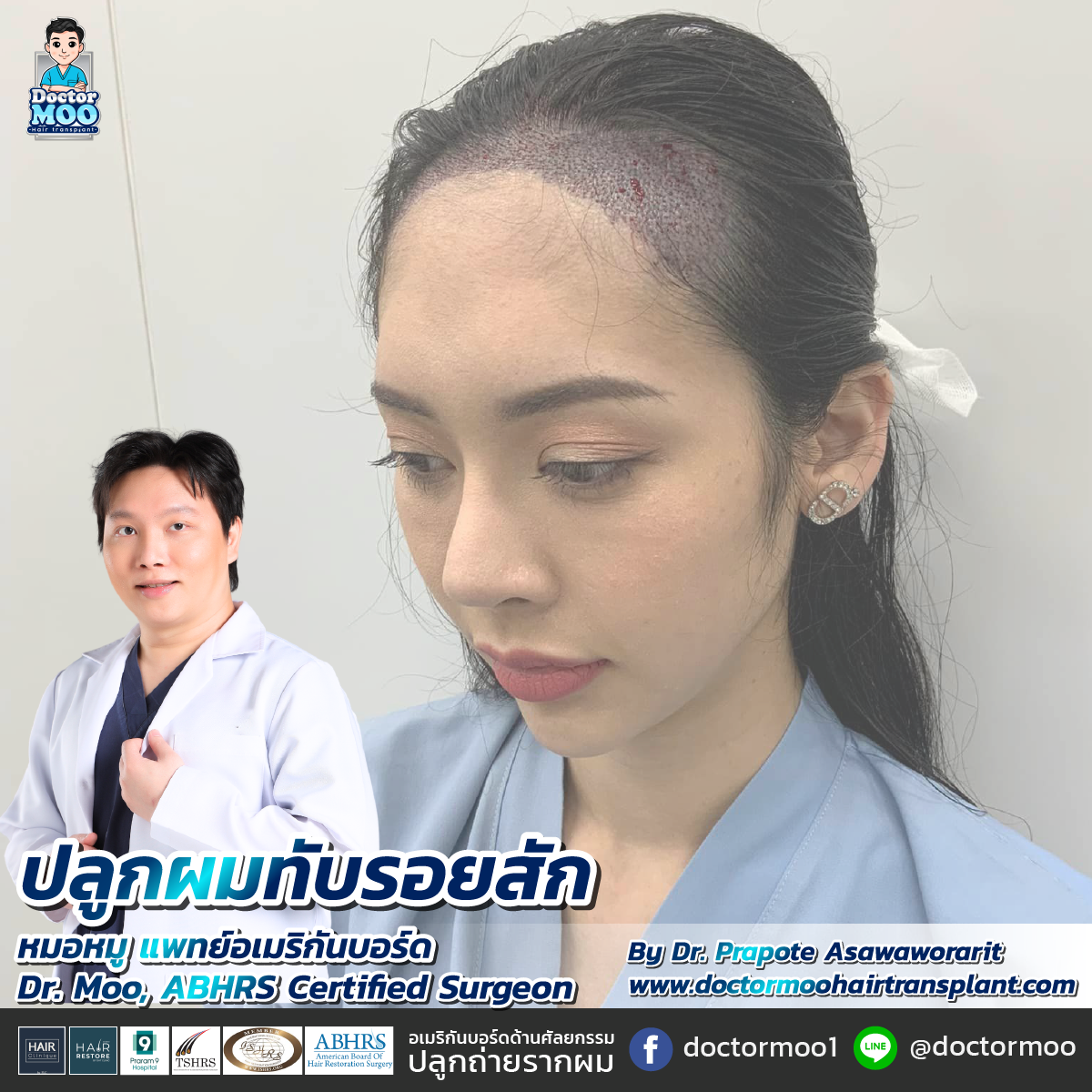 ปลูกผมทับรอยสัก