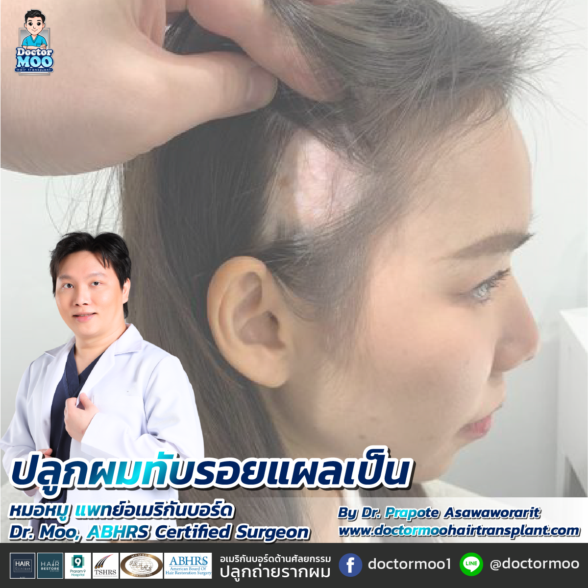 ปลูกผมทับรอยแผลเป็น