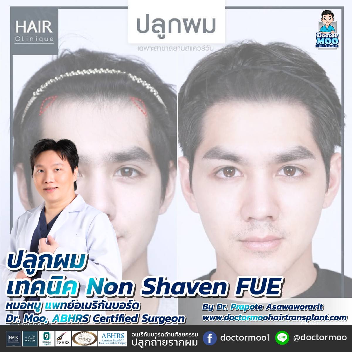 ปลูกผมเทคนิค NON SHAVEN FUE
