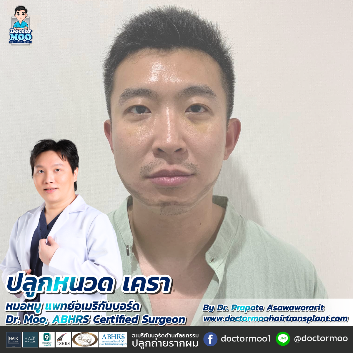 ปลูกหนวด ปลูกเครา