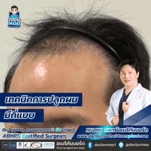 เทคนิคการปลูกผม มีกี่แบบ