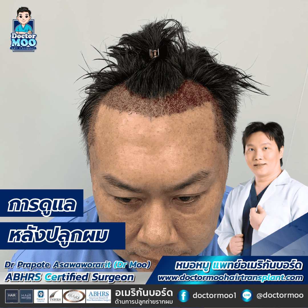 การดูแลหลังปลูกผม การดูแลหลังปลูกผมการดูแลหลังปลูกผม