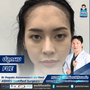 การปลูกผม FUE