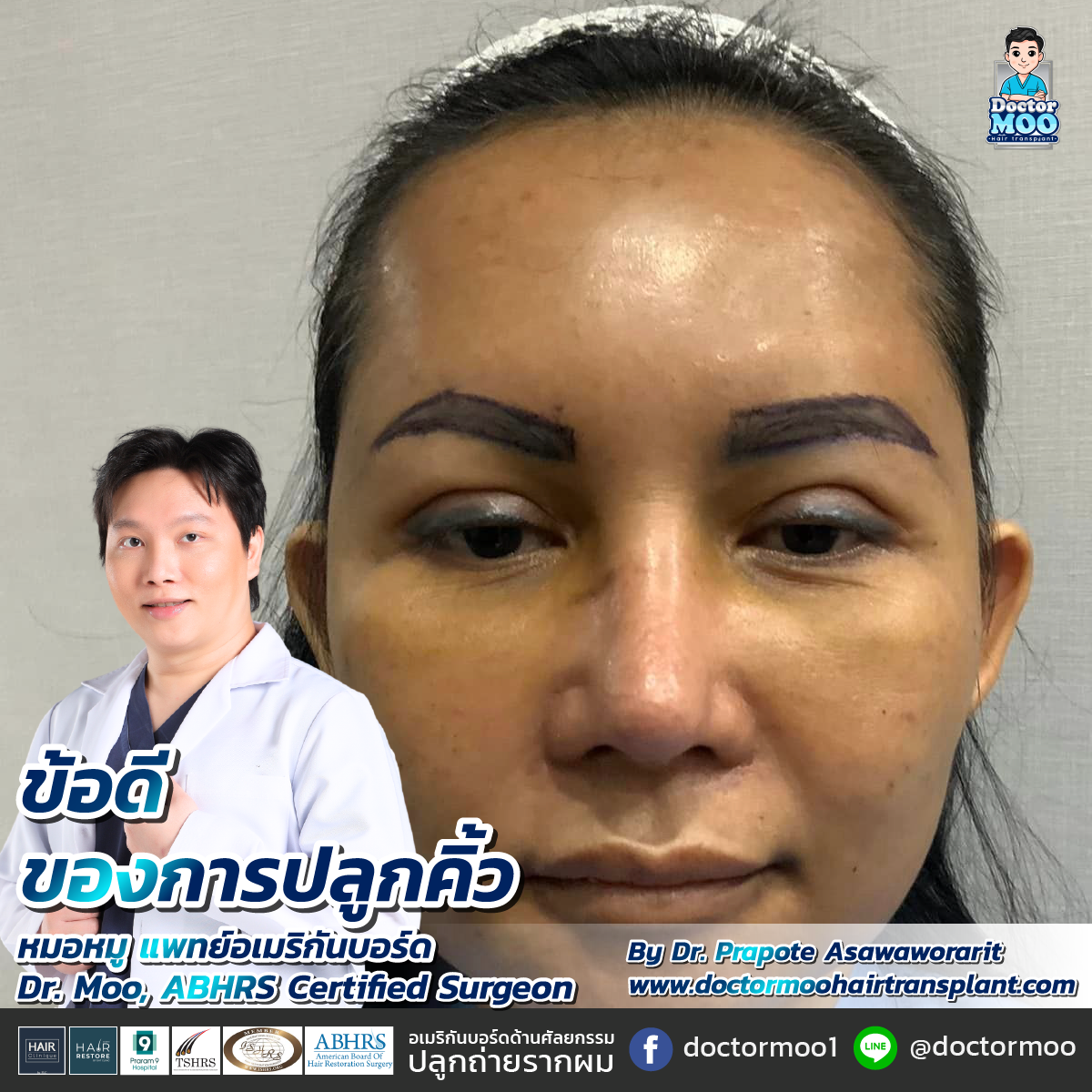 ปลูกขนคิ้ว แก้คิ้วบางได้จริงไหม