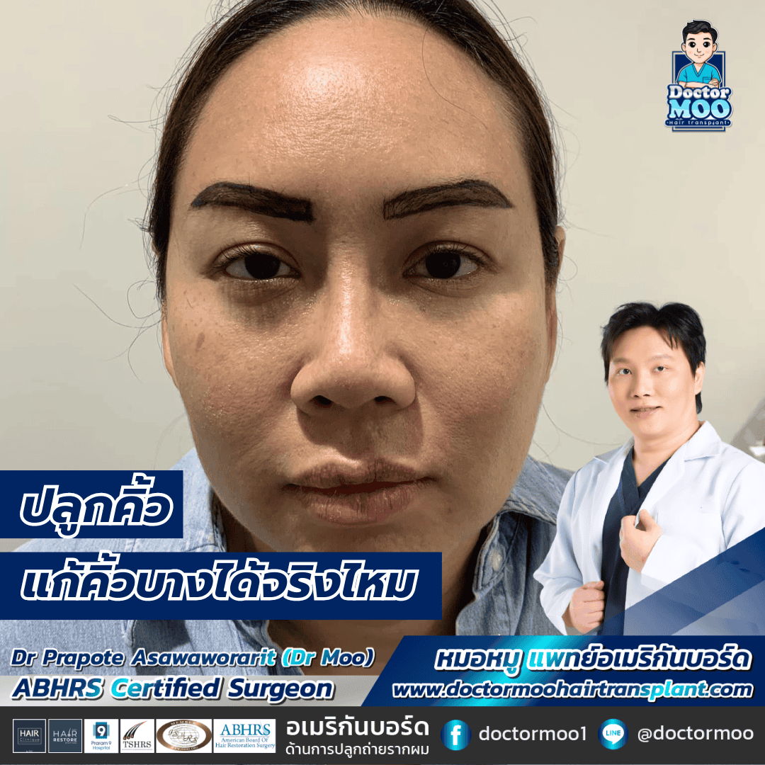 ปลูกขนคิ้ว แก้คิ้วบางได้จริงไหม