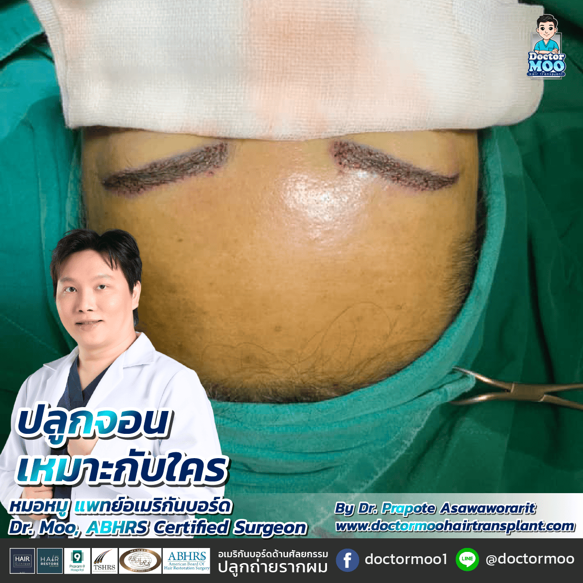 ปลูกขนคิ้ว แก้คิ้วบางได้จริงไหม