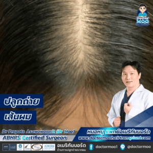 ปลูกถ่ายเส้นผม