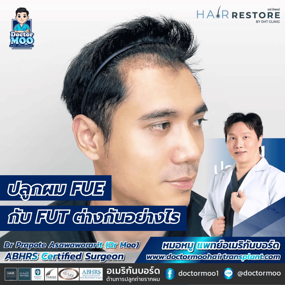 ปลูกผม FUE กับ FUT ต่างกันอย่างไร