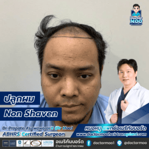 ปลูกผม Non Shaven