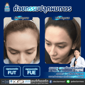 ปลูกผมผู้หญิง