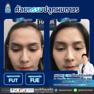 ปลูกผมผู้หญิง