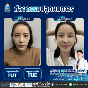 ปลูกผมผู้หญิง