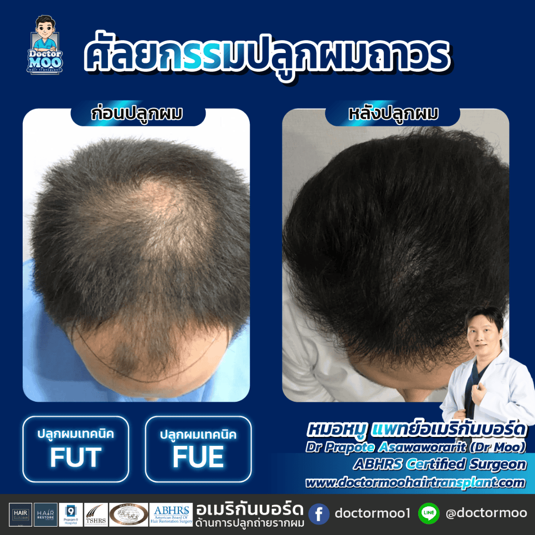 การดูแลหลังปลูกผม การดูแลหลังปลูกผม
