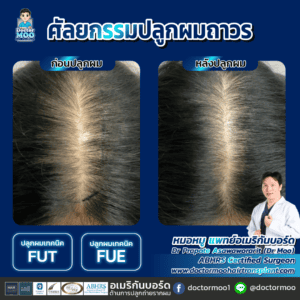 ปลูกผมผู้หญิง