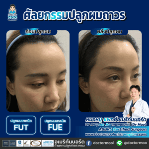 ปลูกผมผู้หญิง