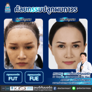 ปลูกผมผู้หญิง