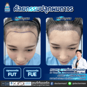 ปลูกผมผู้หญิง