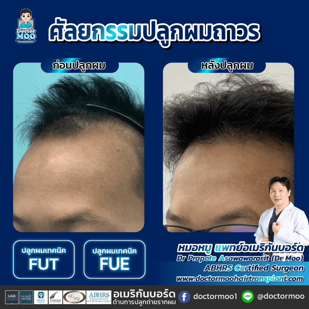 การดูแลหลังปลูกผม การดูแลหลังปลูกผม