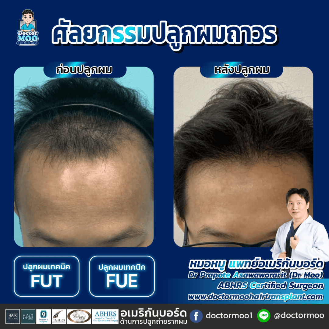 การปลูกผมใช้เวลากี่ชั่วโมง 