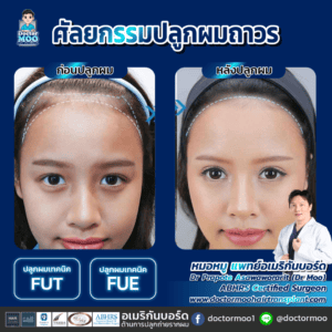 ปลูกผมผู้หญิง