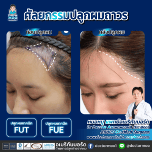 ปลูกผมผู้หญิง ผมร่วงจากฮอร์โมน