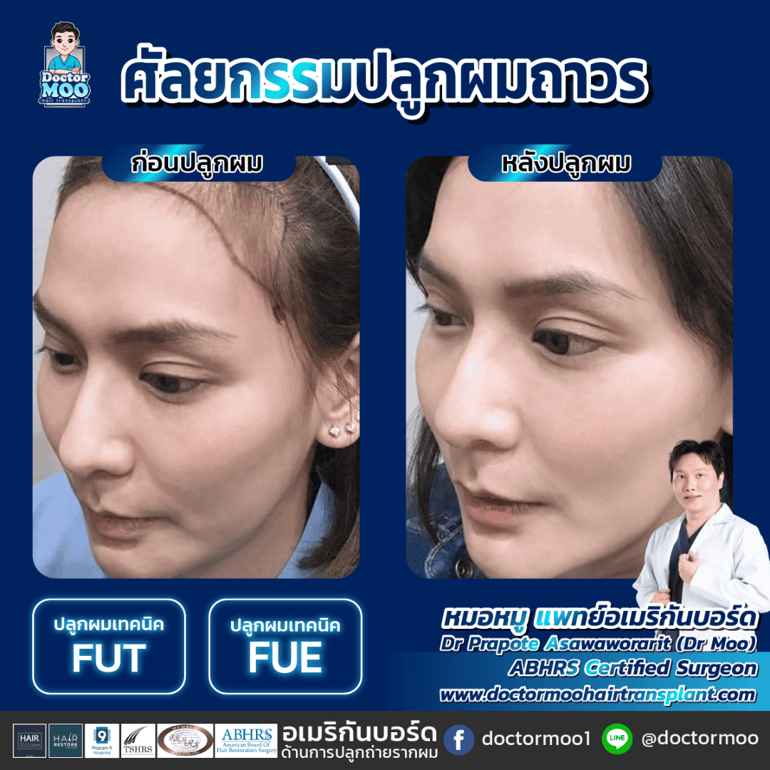 ปลูกผมผู้หญิง ผลข้างเคียง