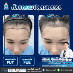 ปลูกผมผู้หญิง ผมร่วงจากกรรมพันธุ์