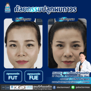 ปลูกผมผู้หญิง ผมร่วงจากกรรมพันธุ์