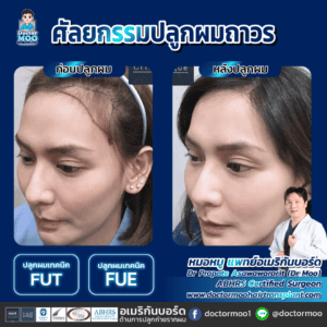 ปลูกผมผู้หญิง