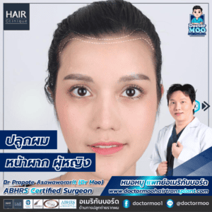 ปลูกผมหน้าผาก ผู้หญิง