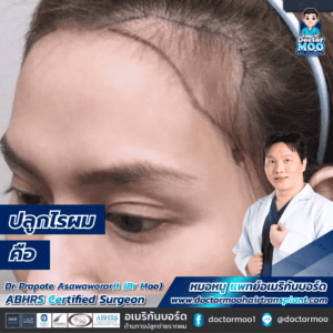 ปลูกไรผม