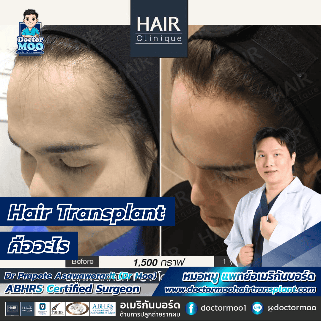 Hair Transplant คืออะไร