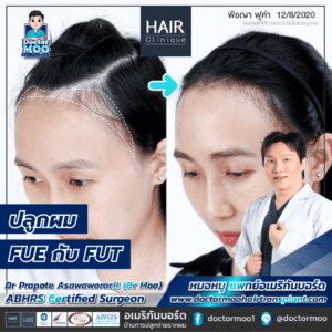 ปลูกผม FUE กับ FUT