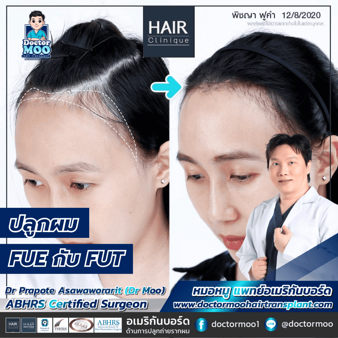 ปลูกผม FUE กับ FUT