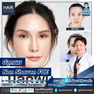 ปลูกผม Non Shaven FUE คืออะไร